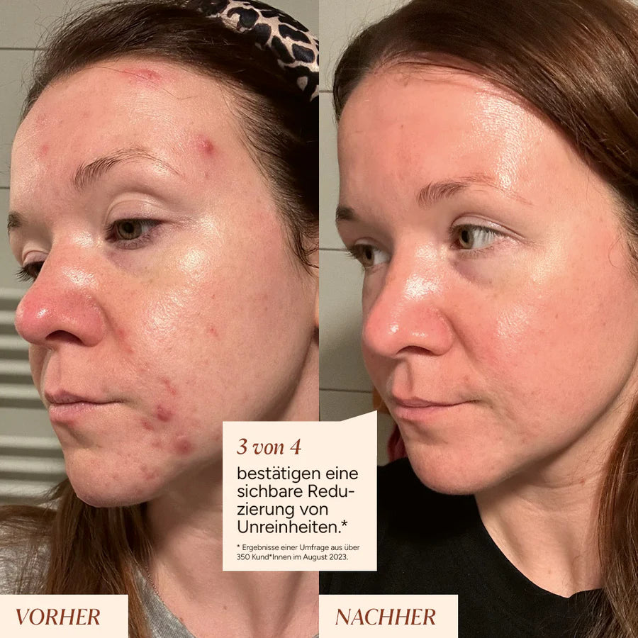 Azelain Serum Studie