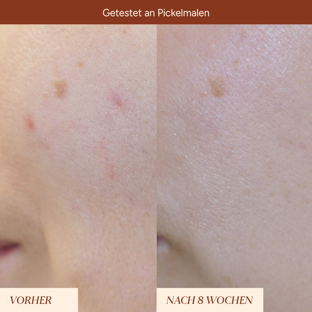 Pigmentflecken & Pickelmale Roll-On