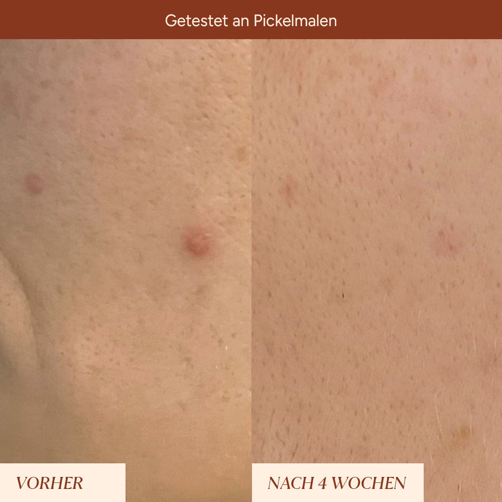 Pigmentflecken & Pickelmale Roll-On