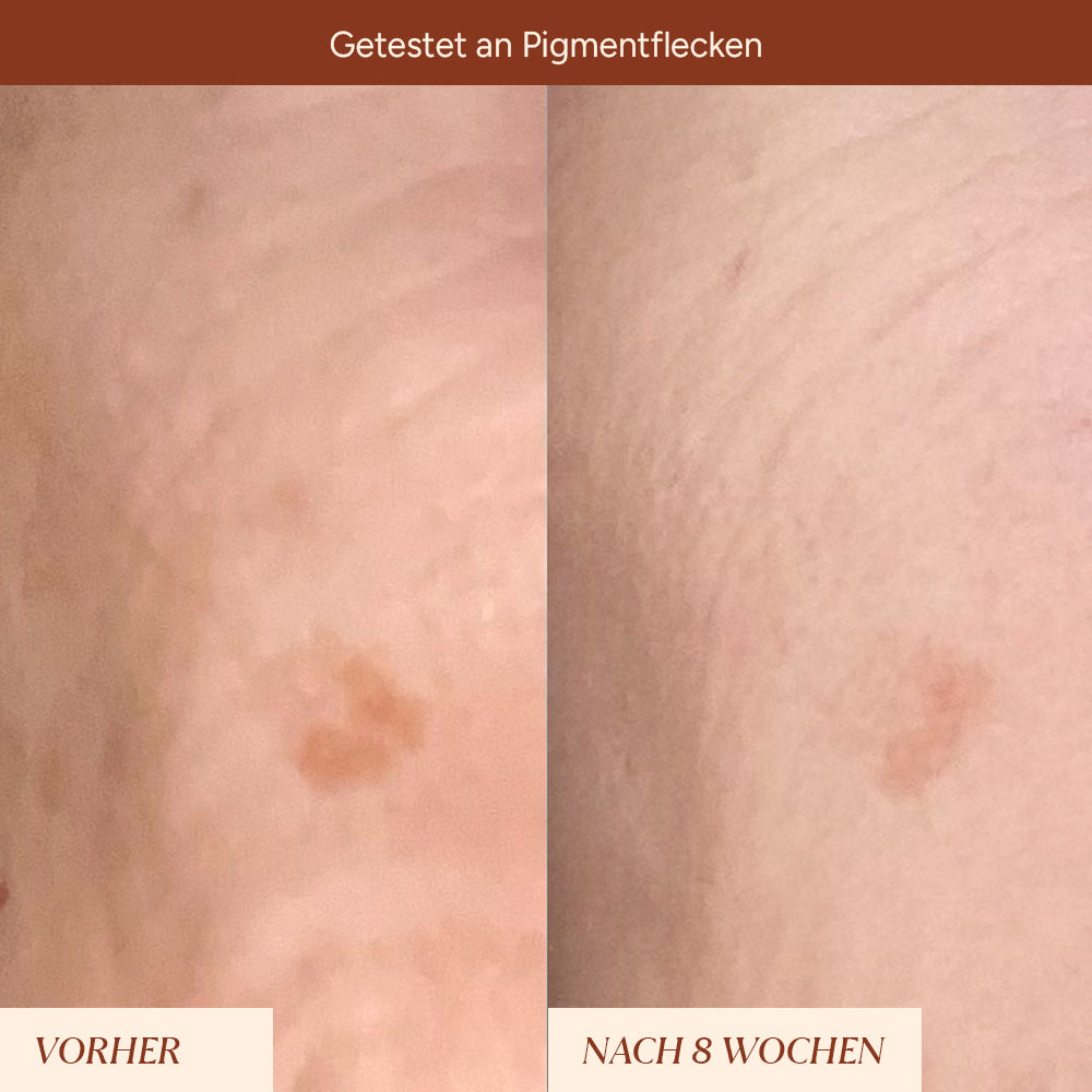Pigmentflecken & Pickelmale Roll-On