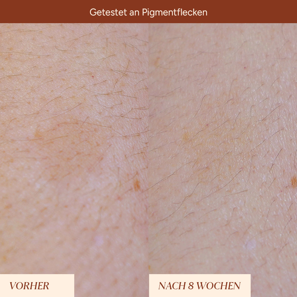 Pigmentflecken & Pickelmale Roll-On