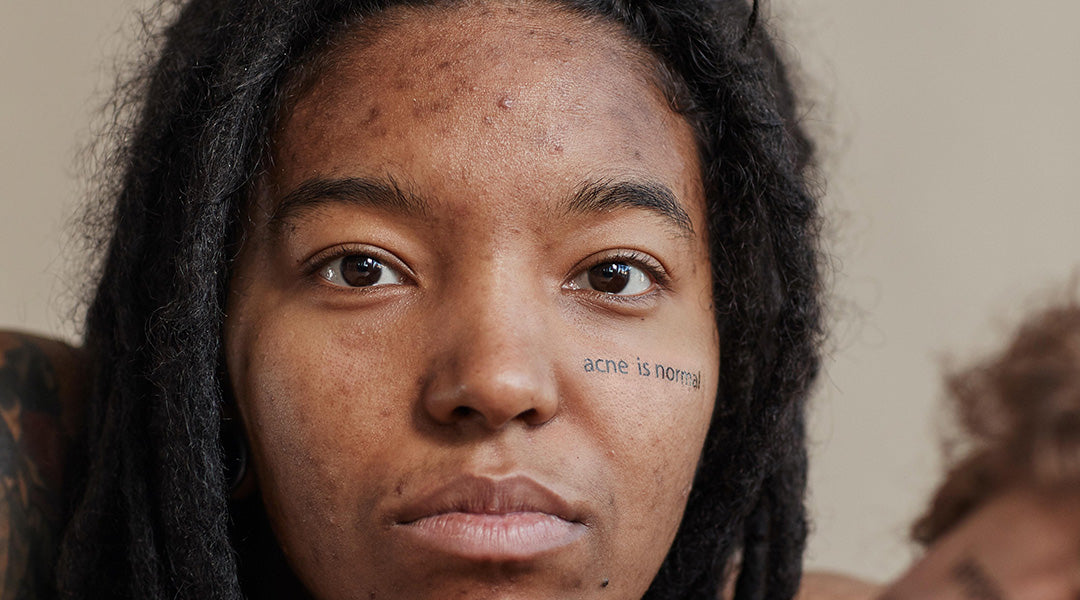 Frau mit Schrift im Gesicht „Acne is Normal“