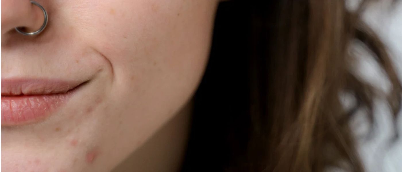 Trockene Lippen, rissige Lippen, rissige Mundwinkel