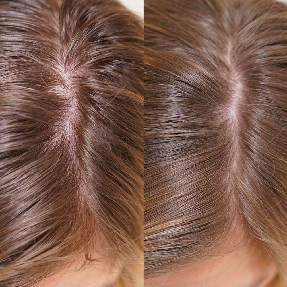 Vergleichsfoto: Haaransatz vor und nach der Anwendung von Trockenshampoo. Links sieht man fettiges, rechts frisches Haar.